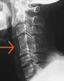 Chiropractic for Phase 3 spinal degeneration