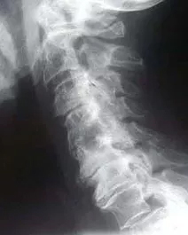 Chiropractic for Phase 4 spinal degeneration